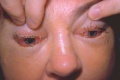 Clinical appearance of eyes in trichinosis by trichinella 3MG0027 lores.jpg