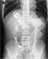 X-Ray Phone swallowed.jpg