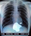 Chest x-ray.jpg