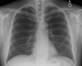 Röntgenbild Brust.jpg